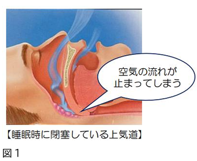 ADHDと睡眠無呼吸症候群_図解1